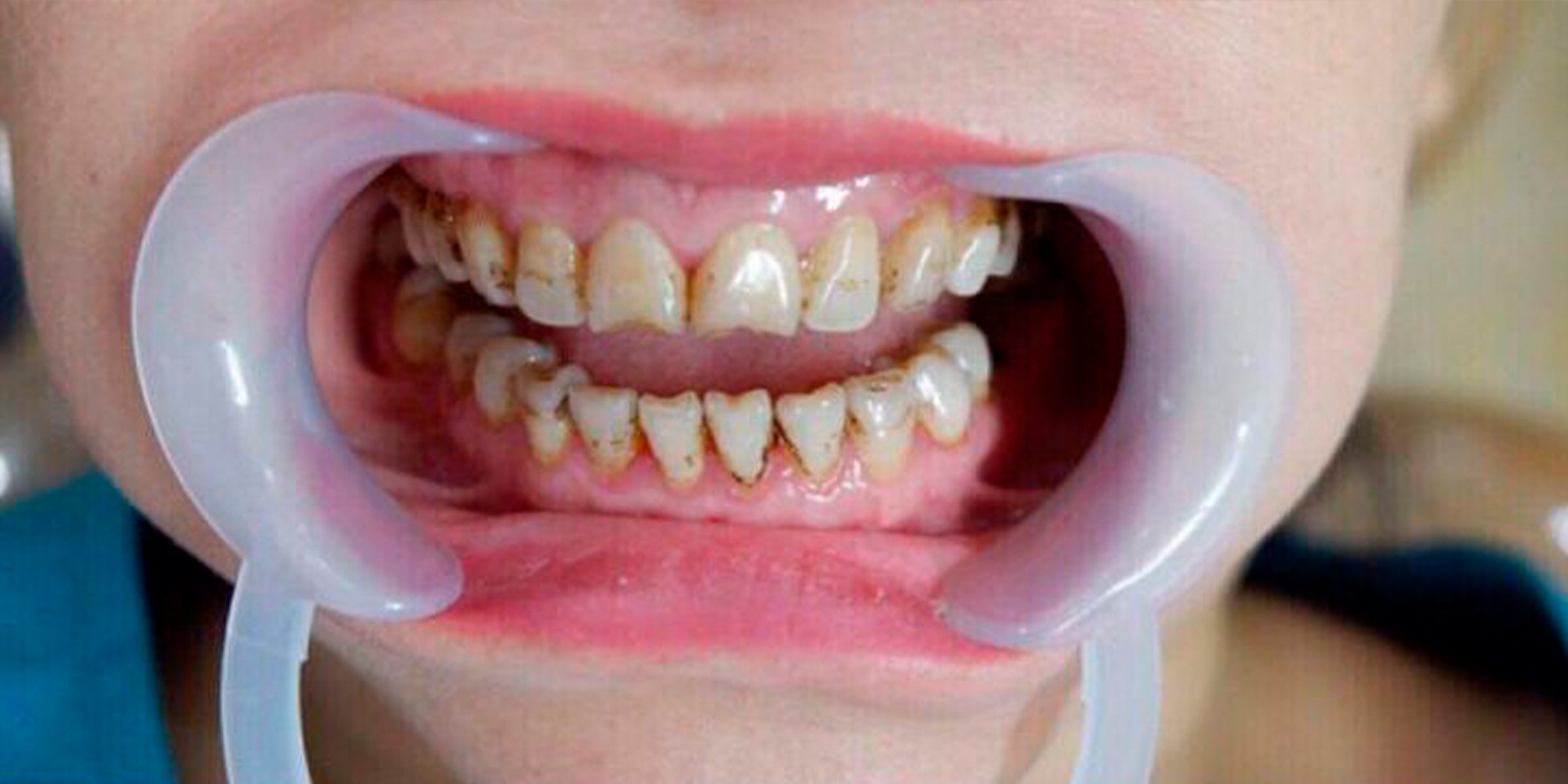 Close-up of man showing his teeth